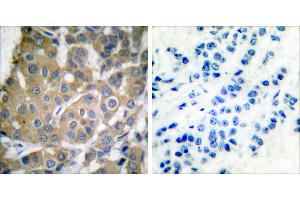 Peptide - +Immunohistochemical analysis of paraffin-embedded human breast carcinoma tissue using Cox2 antibody. (COX2 抗体)