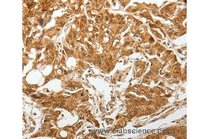 Immunohistochemistry of Human gastric cancer using TGFBR1 Polyclonal Antibody at dilution of 1:60 (TGFBR1 抗体)
