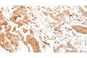 Immunohistochemistry of paraffin-embedded Human colon cancer tissue using ABCA4 Polyclonal Antibody at dilution of 1:30 (ABCA4 抗体)