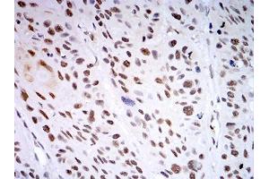 Immunohistochemical analysis of paraffin-embedded esophageal cancer tissues using KDM1A mouse mAb with DAB staining. (LSD1 抗体  (AA 55-263))