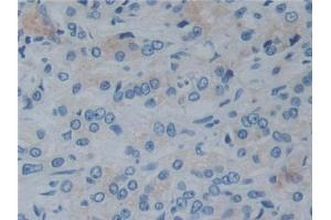 IHC-P analysis of Human Prostate cancer Tissue, with DAB staining. (Reelin 抗体  (AA 2398-2608))