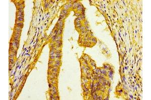 IHC image of ABIN7152029 diluted at 1:100 and staining in paraffin-embedded human colon cancer performed on a Leica BondTM system. (HSD17B1 抗体  (AA 268-328))