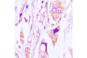 Immunohistochemical analysis of IgG1 staining in human lung cancer formalin fixed paraffin embedded tissue section. (兔 anti-人 IgG1 (Center) Antibody)