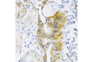Immunohistochemistry of paraffin-embedded human colon carcinoma using CLDN4 antibody (ABIN6133648, ABIN6138690, ABIN6138691 and ABIN6216719) at dilution of 1:150 (40x lens). (Claudin 4 抗体  (C-Term))