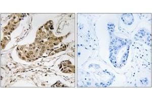 Immunohistochemistry analysis of paraffin-embedded human breast carcinoma tissue, using RTCD1 Antibody. (RTCD1 抗体  (AA 317-366))