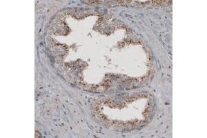 Immunohistochemical staining (Formalin-fixed paraffin-embedded sections) of human prostate with ACAA1 monoclonal antibody, clone CL2662  shows granular cytoplasmic immunoreactivity in glandular cells. (ACAA1 抗体)
