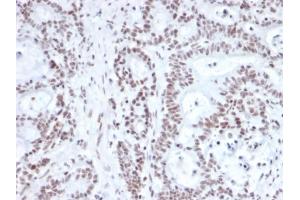 Formalin-fixed, paraffin-embedded human prostate carcinoma stained with NRF1 Mouse Monoclonal Antibody (NRF1/2609). (NFE2L1 抗体)