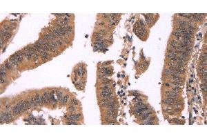 Immunohistochemistry of paraffin-embedded Human colon cancer tissue using FBXO31 Polyclonal Antibody at dilution 1:40 (FBXO31 抗体)
