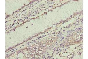 Immunohistochemistry of paraffin-embedded human colon cancer using ABIN7168238 at dilution of 1:100 (RNF11 抗体  (AA 1-154))