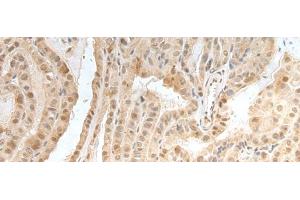 Immunohistochemistry of paraffin-embedded Human thyroid cancer tissue using ZNF24 Polyclonal Antibody at dilution of 1:35(x200) (ZNF24 抗体)