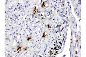 Mast Cell Tryptase was detected in paraffin-embedded sections of human lung cancer tissues using rabbit anti- Mast Cell Tryptase Antigen Affinity purified polyclonal antibody (Catalog # ) at 1 µg/mL. (TPSAB1 抗体  (AA 65-275))