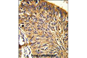 Formalin-fixed and paraffin-embedded human lung carcinoma reacted with PRDX3 Antibody (N-term), which was peroxidase-conjugated to the secondary antibody, followed by DAB staining. (Peroxiredoxin 3 抗体  (N-Term))