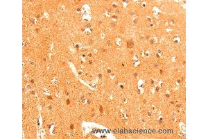 Immunohistochemistry of Human liver cancer using GRM3 Polyclonal Antibody at dilution of 1:50 (Metabotropic Glutamate Receptor 3 抗体)