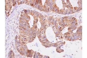 IHC-P Image Aspartyl aminopeptidase antibody [N1N3] detects Aspartyl aminopeptidase protein at cytoplasm on human colon carcinoma by immunohistochemical analysis. (Aspartyl Aminopeptidase 抗体)