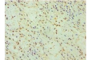 Immunohistochemistry of paraffin-embedded human breast cancer using ABIN7153663 at dilution of 1:100 (Non-Syndromic Hearing Impairment Protein 5 (GSDME) (AA 1-260) 抗体)