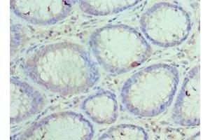 Immunohistochemistry of paraffin-embedded human colon cancer using ABIN7156024 at dilution of 1:100 (HYOU1 抗体  (AA 1-140))