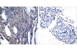 P-Peptide - +Immunohistochemical analysis of paraffin-embedded human breast carcinoma tissue using IκB-α (phospho-Tyr42) antibody. (NFKBIA 抗体  (pTyr42))