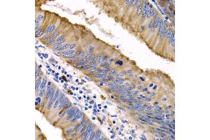 Immunohistochemistry of paraffin-embedded human colon cancer using IL9 antibody (ABIN3015677, ABIN3015678, ABIN1680463 and ABIN6219030) at dilution of 1:200 (40x lens). (IL-9 抗体  (AA 19-144))