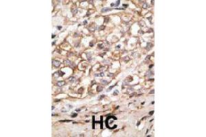 Formalin-fixed and paraffin-embedded human hepatocellular carcinoma tissue reacted with SIGLEC11 polyclonal antibody  , which was peroxidase-conjugated to the secondary antibody, followed by AEC staining. (SIGLEC11 抗体  (C-Term))