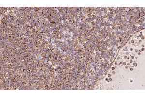 ABIN6273181 at 1/100 staining Human lymph cancer tissue by IHC-P. (TRIM9 抗体  (N-Term))