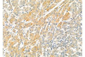 ABIN6265622 and ABIN6273178 at 1/100 staining Human liver cancer by IHC-P.