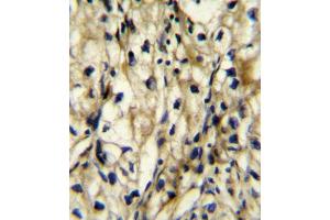 BCAT1 Antibody (Center) (ABIN654106 and ABIN2843989) immunohistochemistry analysis in formalin fixed and paraffin embedded human kidney carcinoma followed by peroxidase conjugation of the secondary antibody and DAB staining. (BCAT1 抗体  (AA 81-107))