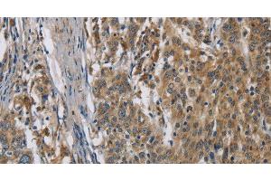 Immunohistochemistry of paraffin-embedded Human gastic cancer using SIGMAR1 Polyclonal Antibody at dilution of 1:50 (SIGMAR1 抗体)