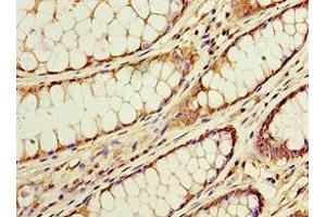 Immunohistochemistry of paraffin-embedded human colon cancer using ABIN7143228 at dilution of 1:100 (ACSM3 抗体  (AA 387-586))