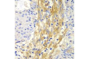 Immunohistochemistry of paraffin-embedded human oophoroma using FLNA antibody (ABIN5975863) at dilution of 1/100 (40x lens). (Filamin A 抗体)