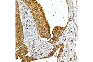 Immunohistochemistry of paraffin-embedded human colon carcinoma using VAPB Rabbit pAb (ABIN6132783, ABIN6150058, ABIN6150059 and ABIN6221003) at dilution of 1:50 (40x lens). (VAPB 抗体  (AA 10-222))