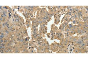 Immunohistochemistry of paraffin-embedded Human ovarian cancer using PSMD9 Polyclonal Antibody at dilution of 1:50 (PSMD9 抗体)