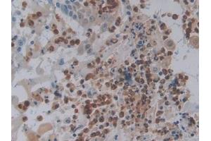 Detection of FOS in Human Skin cancer Tissue using Polyclonal Antibody to V-Fos FBJ Murine Osteosarcoma Viral Oncogene Homolog (FOS) (FOS 抗体  (AA 55-298))