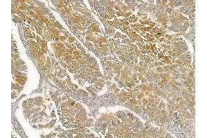 ABIN6257069 and ABIN6274978 at 1/100 staining human lung squamous cell carcinoma by IHC-P. (CNOT4 抗体  (N-Term))