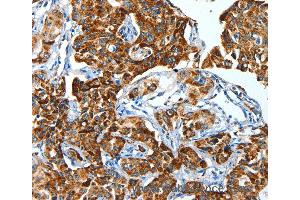 Immunohistochemistry of Human lung cancer using ALDH6A1 Polyclonal Antibody at dilution of 1:45 (ALDH6A1 抗体)