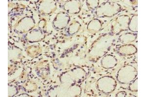 Immunohistochemistry of paraffin-embedded human gastric cancer using ABIN7154322 at dilution of 1:100 (GBF1 抗体  (AA 1-85))