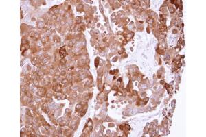 IHC-P Image Immunohistochemical analysis of paraffin-embedded OVCAR3 xenograft, using PPA1, antibody at 1:500 dilution. (Pyrophosphatase (Inorganic) 1 (PPA1) 抗体)
