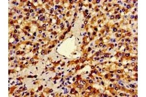 Immunohistochemistry of paraffin-embedded human liver cancer using ABIN7144300 at dilution of 1:100 (ANO1 抗体  (AA 1-151))