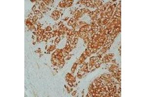 Formalin-fixed, paraffin-embedded  human breast carcinoma stained with Heat Shock Protein 27  using peroxidase-  conjugate and DAB chromogen. (HSP27 抗体)