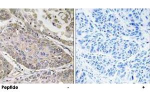 Immunohistochemistry analysis of paraffin-embedded human lung carcinoma tissue using PLA2G4E polyclonal antibody . (PLA2G4E 抗体)
