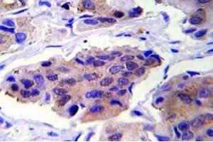 Immunohistochemistry (IHC) analyzes of GSK3alpha pAb in paraffin-embedded human breast carcinoma tissue. (GSK3 alpha 抗体)