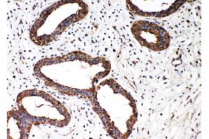 Anti-Smad2 antibody, IHC(P) IHC(P): Human Mammary Cancer Tissue