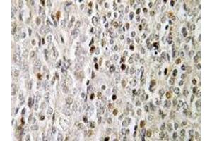 Immunohistochemistry analyses of FOXE3 in human prostate carcinoma tissue (Formalin-fixed, Paraffin-embedded) using FOXE3 / FKHL12 antibody . (FOXE3 抗体)