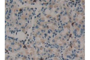 IHC-P analysis of Human Stomach cancer Tissue, with DAB staining. (Midkine 抗体  (AA 22-143))