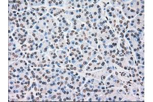 Immunohistochemical staining of paraffin-embedded Adenocarcinoma of ovary tissue using anti-CHEK2mouse monoclonal antibody. (CHEK2 抗体)