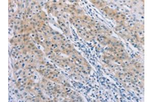 The image on the left is immunohistochemistry of paraffin-embedded Human gastric cancer tissue using ABIN7189712(AGAP2 Antibody) at dilution 1/30, on the right is treated with synthetic peptide. (AGAP2 抗体)