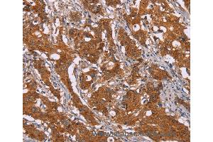 Immunohistochemistry of Human breast cancer using DCTN6 Polyclonal Antibody at dilution of 1:40 (DCTN6 抗体)