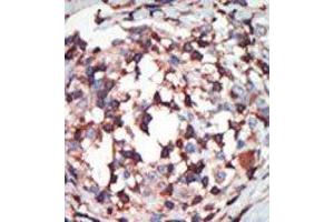Formalin-fixed and paraffin-embedded human cancer tissue reacted with the primary antibody, which was peroxidase-conjugated to the secondary antibody, followed by AEC staining. (PKC beta 抗体  (C-Term))