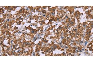 Immunohistochemistry of paraffin-embedded Human thyroid cancer using Cyclophilin F Polyclonal Antibody at dilution of 1:45 (PPIF 抗体)