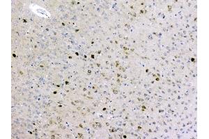 IHC analysis of GOLPH3 using anti-GOLPH3 antibody (ABIN6719570). (GOLPH3 抗体  (AA 56-298))