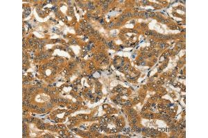 Immunohistochemistry of Human thyroid cancer using ADCY3 Polyclonal Antibody at dilution of 1:50 (ADCY3 抗体)
